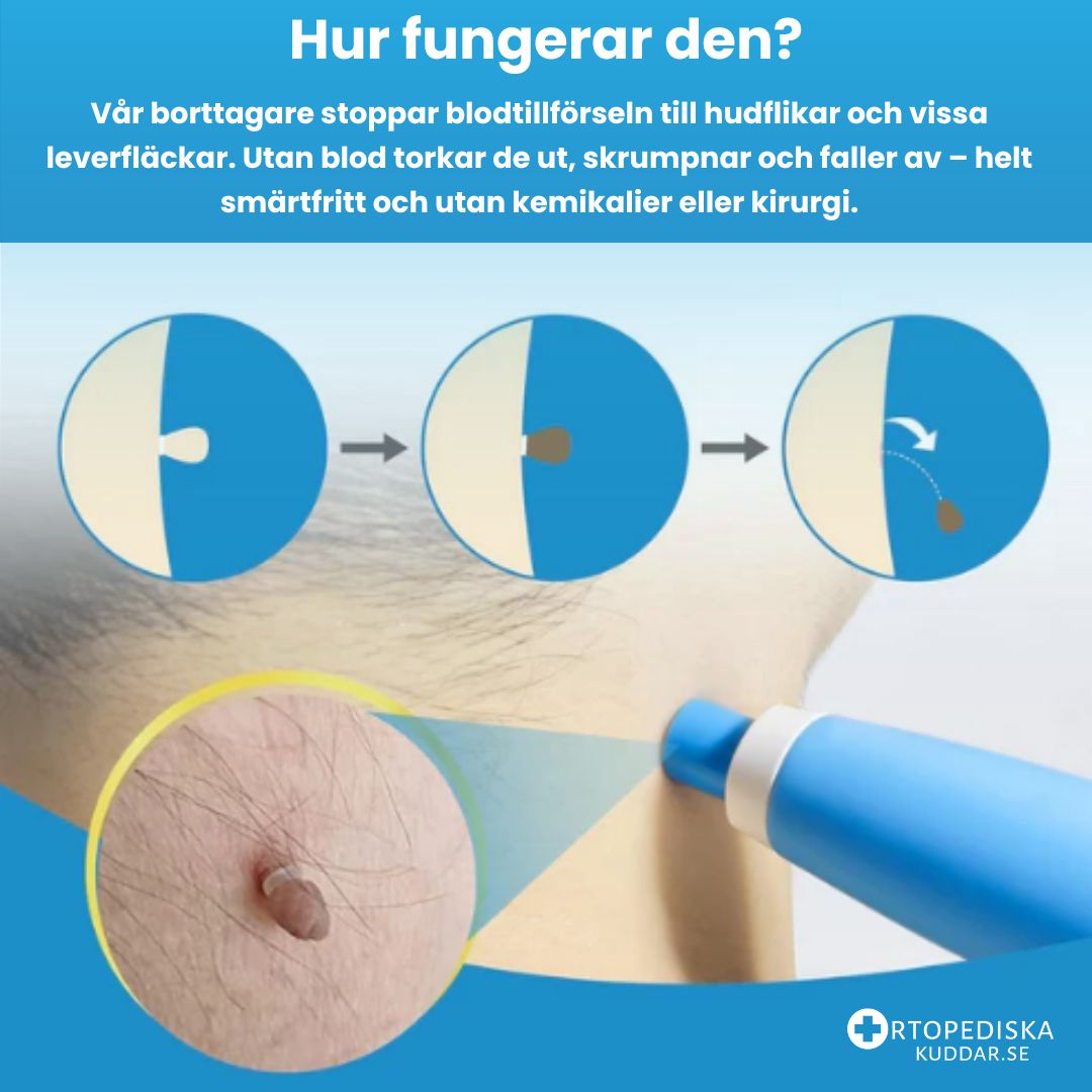 Leverfläcksborttagning & Hudflikborttagningskit – Enkel och Naturlig Behandling Hemma